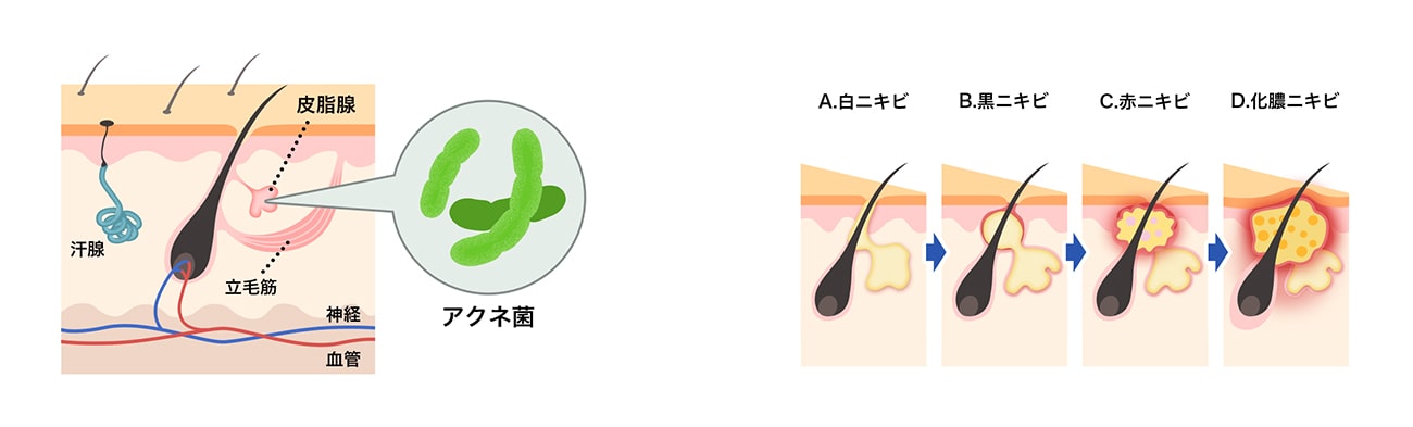 ニキビができる過程の説明画像