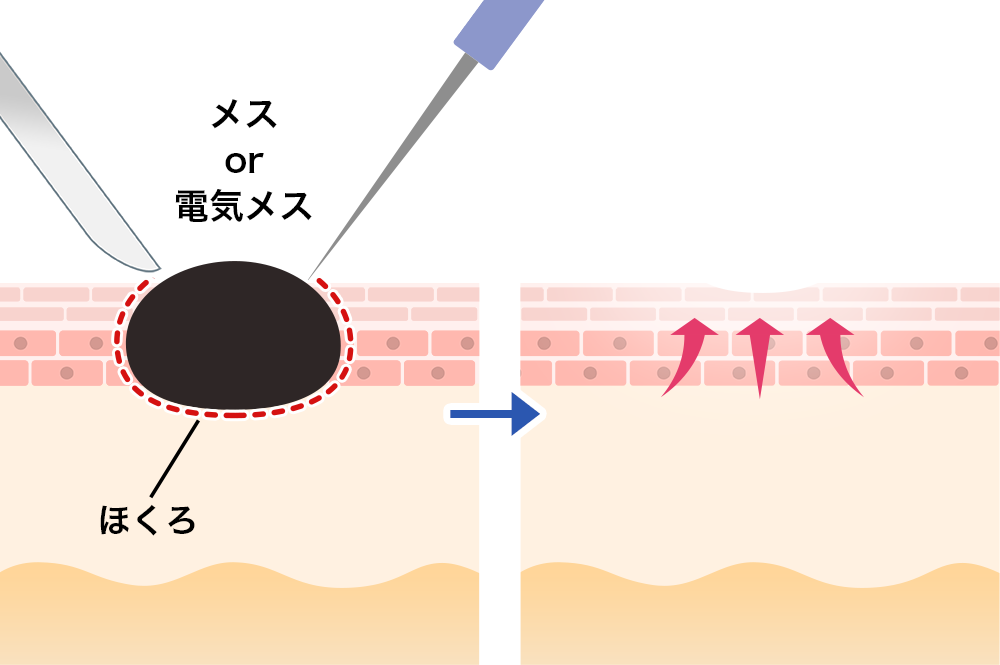 ほくろ（母斑細胞母斑）取りの施術方法の説明画像