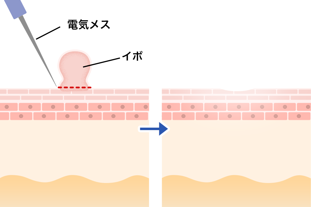 いぼ（尋常性疣贅）取り施術方法の説明画像